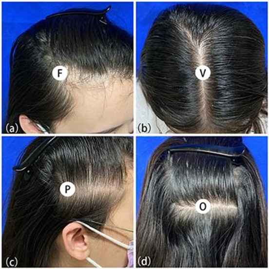 Causes Of Female Hair Loss – Hair Loss Tips